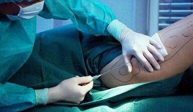 Weight loss surgery